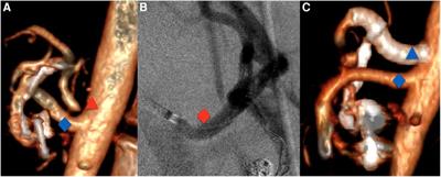 Systematic hybrid laparoscopic and endovascular treatment of median arcuate ligament syndrome: A single-center experience